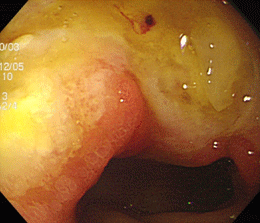 十二指腸潰瘍（薬剤性；ピロリ菌陰性）左