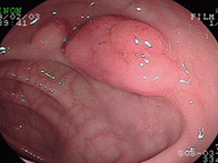 大腸ポリープ1上段左