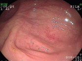 Collagenous colitis( “膠原繊維性大腸炎”)上段左