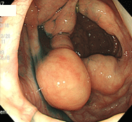 腸管嚢胞様気腫症中央
