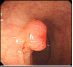 大腸がん（SM深部浸潤がん）最左