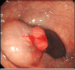 大腸がん（SM深部浸潤がん）左