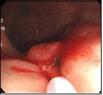 大腸がん（SM深部浸潤がん）右