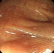 大腸メラノーシス中央