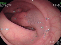 大腸ポリープ1上段中央
