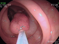 大腸ポリープ1上段右