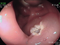 大腸ポリープ1下段左