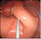 大腸ポリープ2上段左