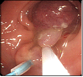 大腸ポリープ2上段中央