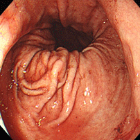 胃食道逆流症（逆流性食道炎）中央