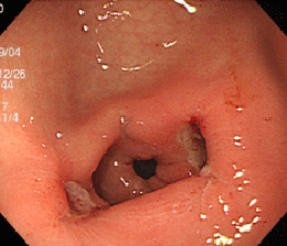 胃潰瘍（薬剤性；ピロリ菌陰性)左