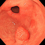 胃ポリープ①（過形成性ポリープ）上段左