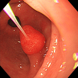 胃ポリープ①（過形成性ポリープ）上段中央