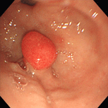 胃ポリープ①（過形成性ポリープ）下段左