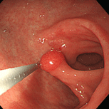 胃ポリープ①（過形成性ポリープ）下段中央