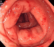 細菌性腸炎（カンピロバクター腸炎）上段中央