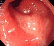細菌性腸炎（カンピロバクター腸炎）下段中央